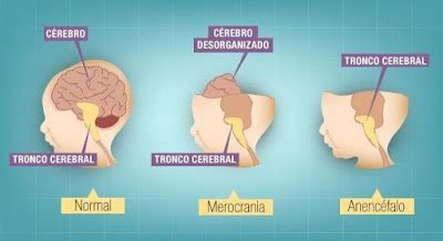 Anencefalia O Que É - Regeneração do Bem: Anencefalia