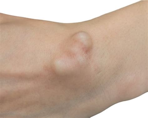 wrist ganglion cyst disease ganglion cyst  fluid filled lump