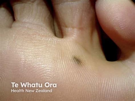 acral lentiginous melanoma images dermnet