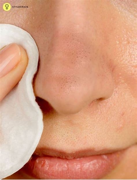 rid  blackheads beauty beauty  fleek