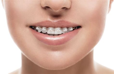 orthodontie pour adultes quelles techniques quel cout