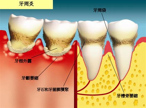 Dental hong kong, 香港牙科: 牙周病的成因及過程