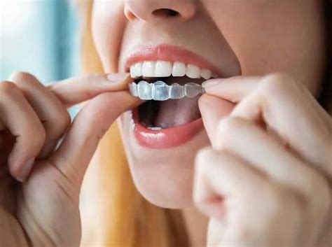 Best Removable Braces in the UK? Compare Brands & Costs