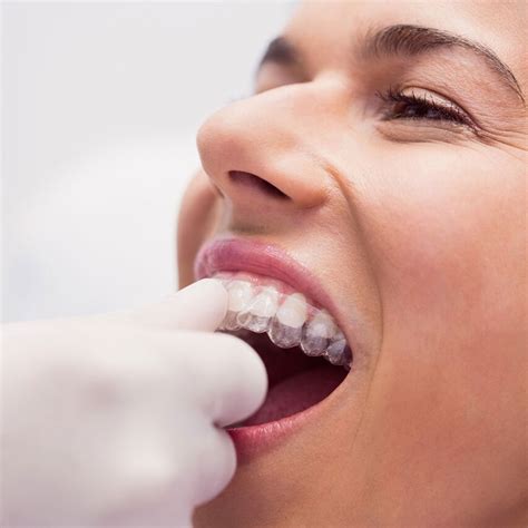 teeth straightening  clear aligners work