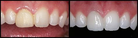 Mothlhtqqjbpqdp: Root Canal Front Tooth Before And After