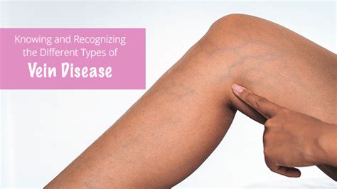 knowing  recognizing   types  vein disease summit