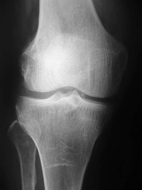 knee x-ray - Swiesz Family Chiropractic