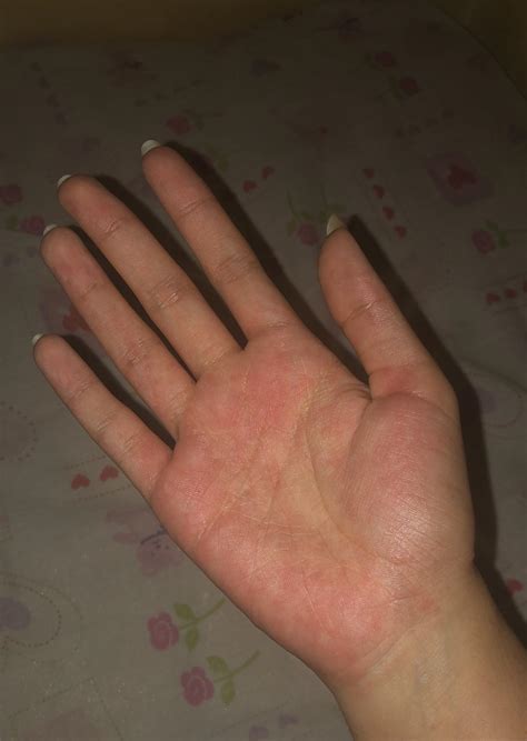 These little bumps showed up on my foot 2 days ago. They are super