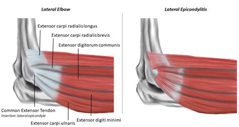 Lateral Epicondylitis Lateral Epicondylitis (Tennis Elbow)