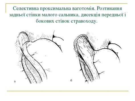 Хірургія шлунку, ДПК. ПГР та ПВ синдроми у хворих - презентація з медицини
