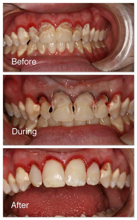 Tooth Cavity Filling Before And After