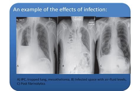 A) Shows the chest x-ray of a mesothelioma patient with a trapped lung... | Download Scientific ...