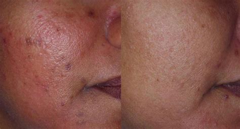 post inflammatory hyperpigmentation pih treatment brisbane cutis clinic