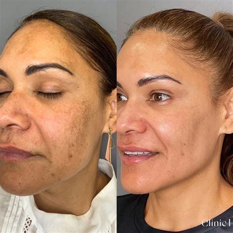 how to rid melasma 7