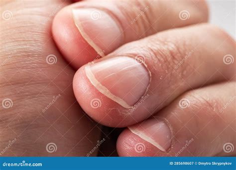 Ridged Fingernails with Vertical Ridges.Nails Problems Stock Image ...