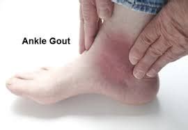 Ankle-Gout - Delhi Pain Management Centre