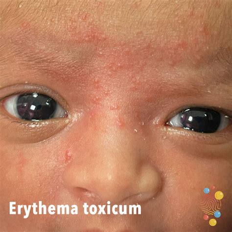 erythema toxicum skin deep