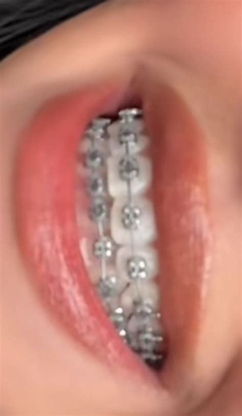 gray braces  stunning smile transformation