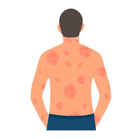 Dermatological skin disease, psoriasis.Allergic itching, skin