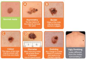 malignant melanoma treatment dorset bournemouth christchurch