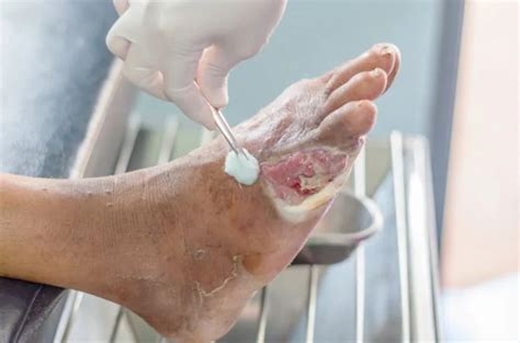 Diabetic Foot Care - Sri Lakshmi Hospital
