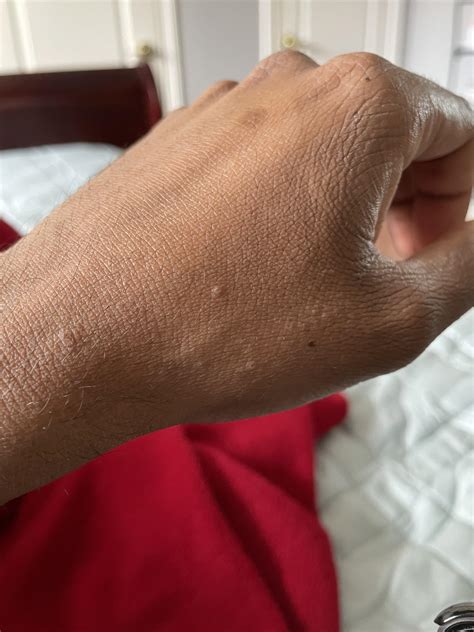 Causes Of Fluid Filled Bumps On The Skin That Cause Itching