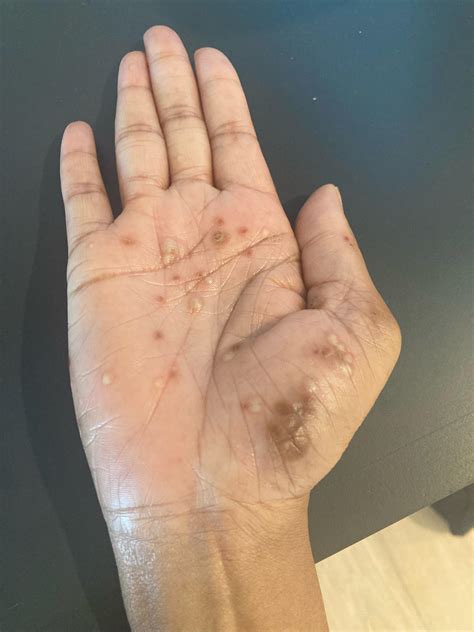 Rocky Mountain Spotted Fever or Palmoplantar Pustulosis? : r/Autoimmune