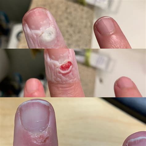 Did I achieve success or do I need to mess with it more? : r/Warts