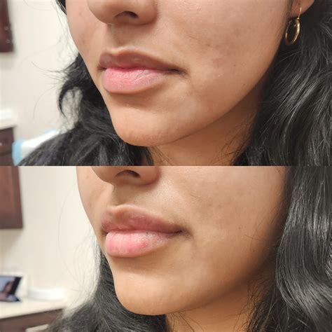 Lip Injections in Thousand Oaks, Oxnard, Ventura, Camarillo