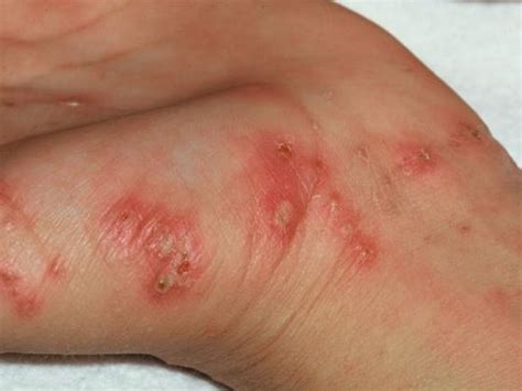 scabies images symptoms  treatments