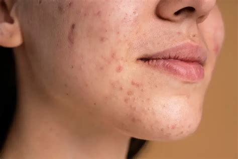 How to Get Rid of PIH (Post Inflammatory Hyperpigmentation) - Revea
