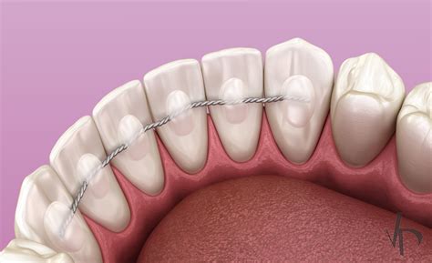 Orthodontic Retainer Top Teeth Retainer In Dubai | Al Hana Modern