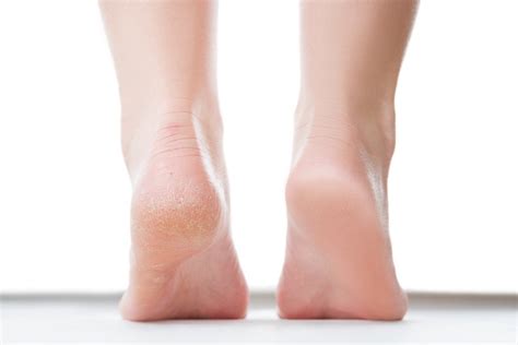 Why Are Your Feet Peeling? Causes for Peeling Feet - Parade