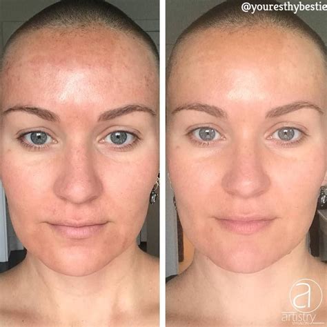 Microneedling Before And After Results | Before And After