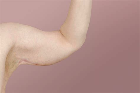 short scar arm lift gulglam clinics