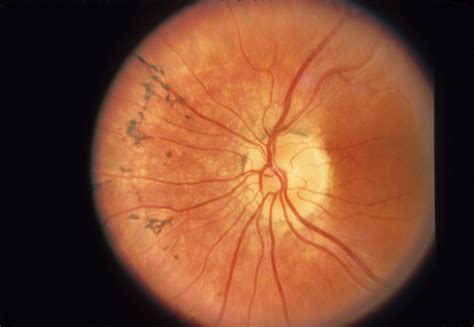 retinopathy retinopathy pigmentosa