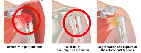 Supraspinatus Tear - Signs, Symptoms and Diagnosis