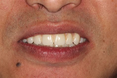 Upper and lower All-on-Four permanent ceramic fixed bridges using