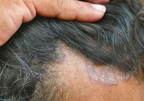 seborrheic dermatitis  psoriasis   scalp