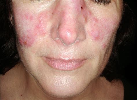 Lupus - Systemic Lupus Erythematosus (SLE) - Causes, Sign & Symptoms