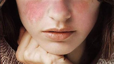 mei diperingati hari lupus sedunia ketahui tanda  gejala