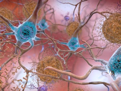 Cause of Alzheimer's disease may be completely different than we think ...