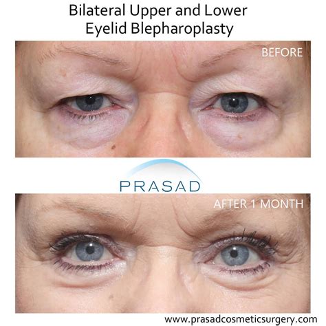 How Hooded Eye Surgery Scars are Minimized | Dr. Prasad Blog