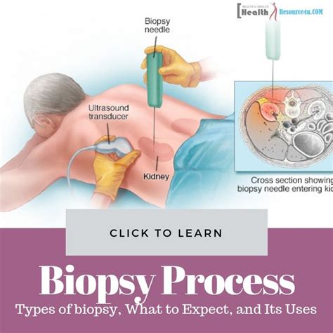 biopsy types  biopsy   expect    types