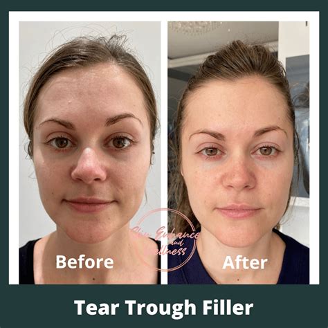 Tear trough filler | Skin Enhance And Wellness