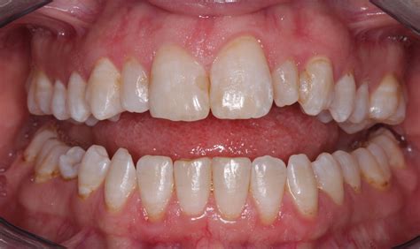 Can I do anything to make my teeth look better? : r/askdentists