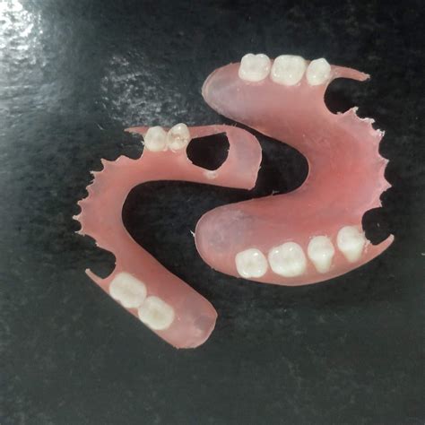 Affordable Flexible Valplast Customized Partial Denture (Pink, Valplast ...