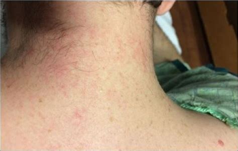 Rash Of Still's Disease at Savannah Holroyd blog