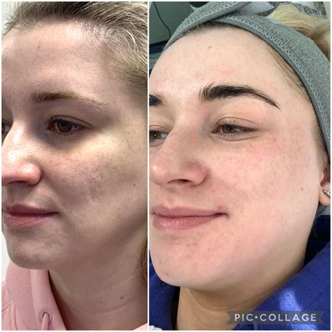 Micro Needling Dublin - Facial Rejuve