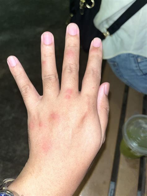 Rashes on wrists, elbows. Ant idea what could it be? : r